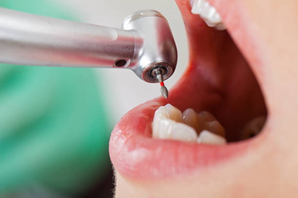 Best Emergency Root Canal Treatment in Grundy, VA
